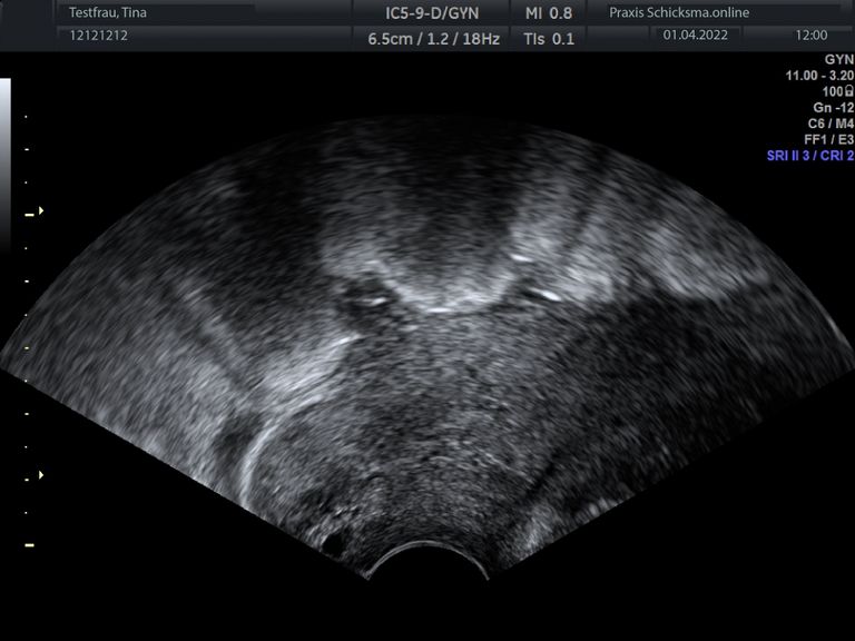 Baby-Ultraschallbilder